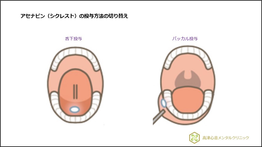 アセナピン（シクレスト）の投与方法の切り替え