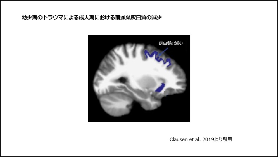 幼少期のトラウマによる成人期における前頭葉灰白質の減少