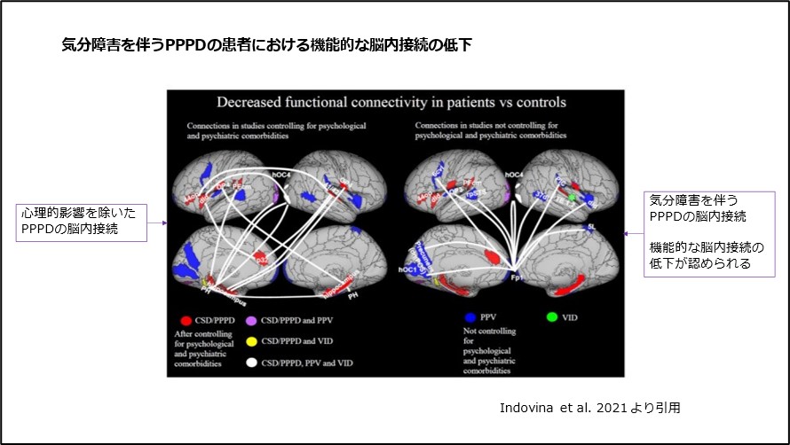 気分障害を伴うPPPDの患者における機能的な脳内接続の低下