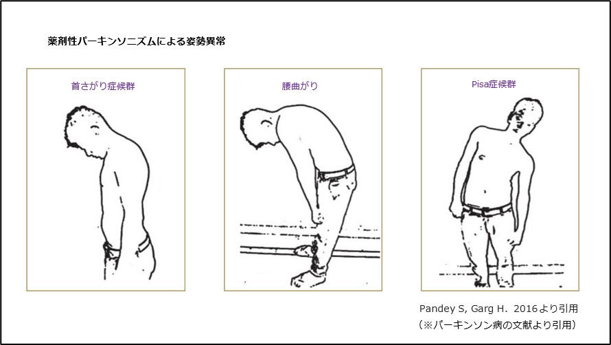 薬剤性パーキンソニズムによる姿勢異常