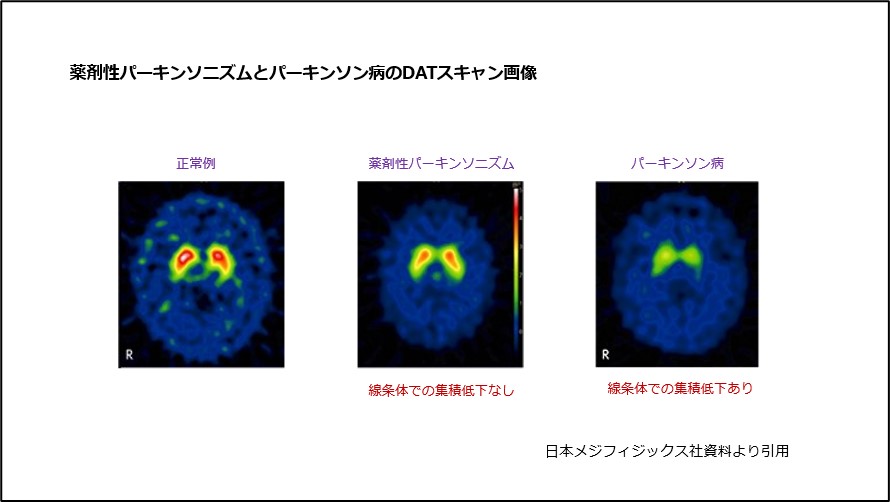 薬剤性パーキンソニズムとパーキンソン病のDATスキャン画像