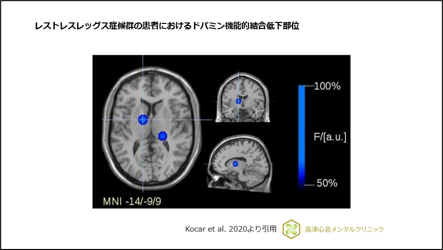 レストレスレッグス症候群の患者におけるドパミン機能的結合低下部位