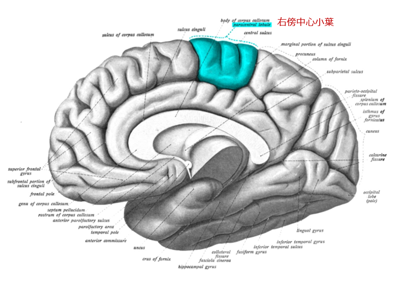 アレキシサイミアでは、脳の皮質の厚みに変化が生じることが報告されている