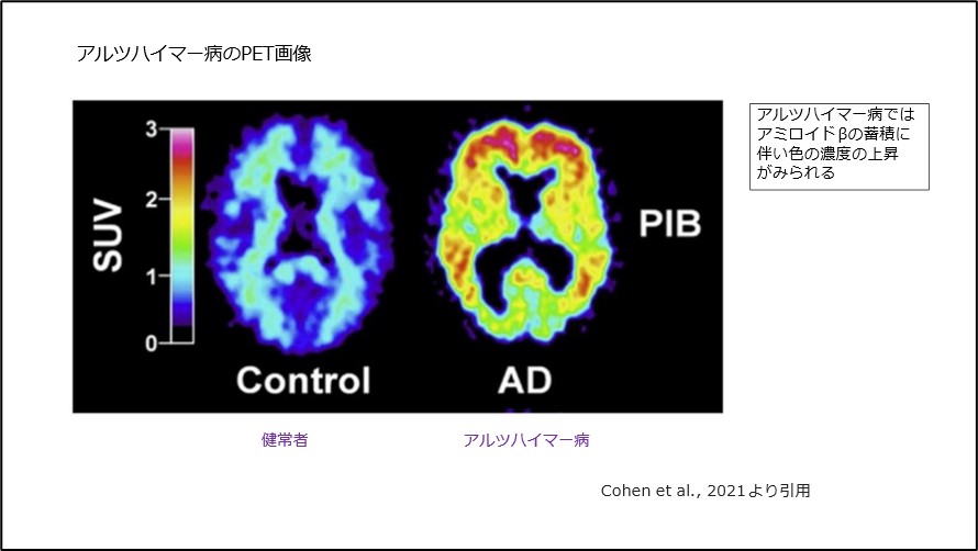 アルツハイマー病の新規治療薬「レカネマブ」について｜川崎市の