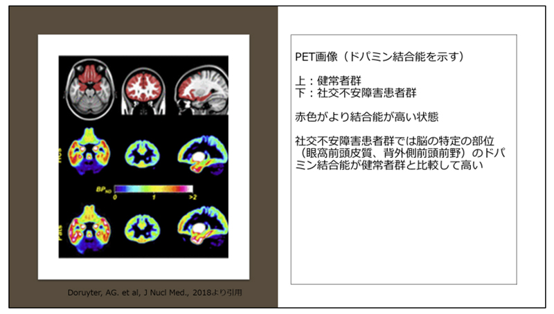 社交 不安 障害