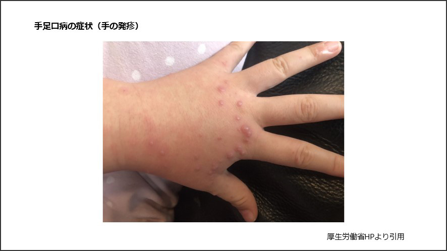 手足口病の症状(手の発疹)